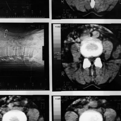 Traumatic Brain Injury Lawyer SACRAMENTO CA Gingery Hammer Associates LLP